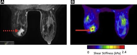 Mr Elastography Of The Breast Evolution Of Technique Case Examples