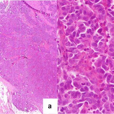 Cutaneous Metastasis Of Lung Adenocarcinoma Immunohistochemistry Download Scientific Diagram