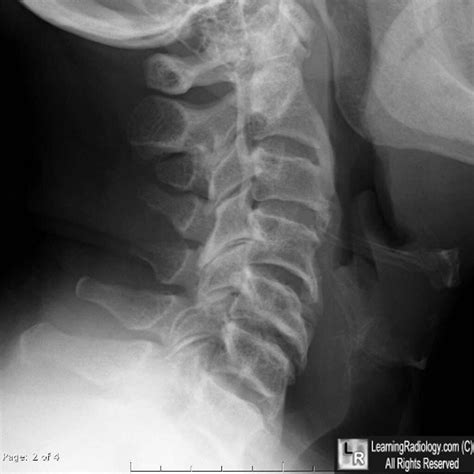 Learningradiology Ossification Posterior Longitudinal Ligament Opll Spine Dish