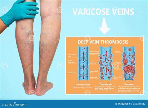 Trombosi Da Flusso Sanguigno Normale A Formazione Del Coagulo Di Sangue