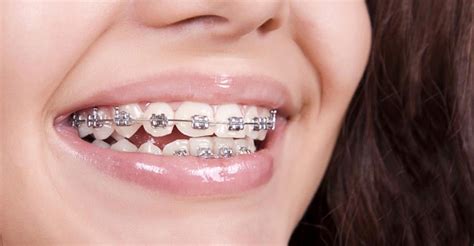 keeping-your-teeth-healthy-while-you-have-braces - Weston Dental Office