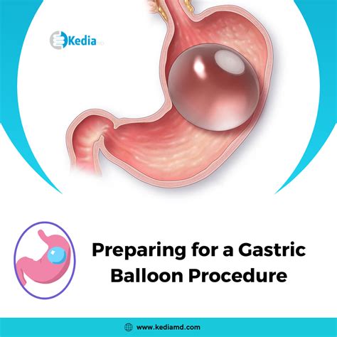 Preparing for a Gastric Balloon Procedure: Dallas, Tx