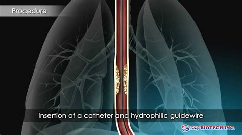 Sandg Biotech Egis Esophageal Stent Youtube