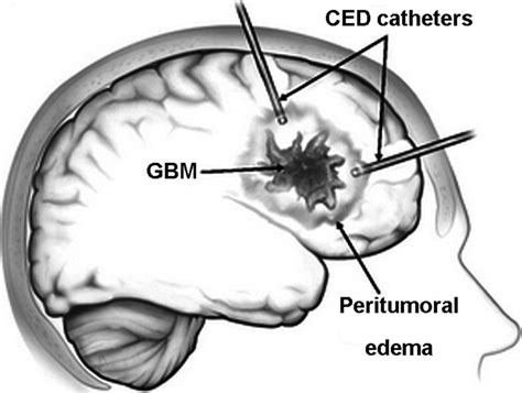 Exploring The Interstitial System In The Brain The Last Mile Of Drug