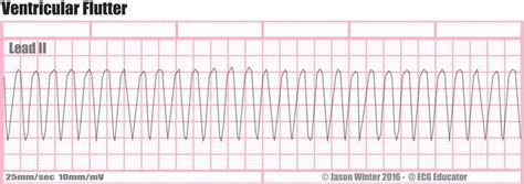 Pin On Six Second Ecg Strips