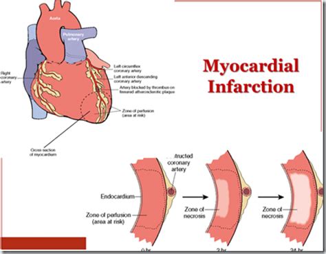 Aplikasi Stem Cell Untuk Infarksi Miokard Akut Acute Myocard Infark