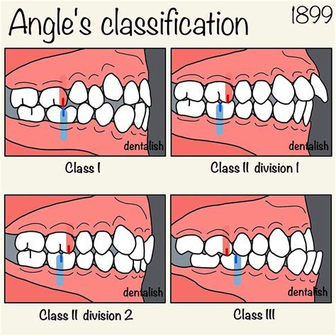 Class Ii Malocclusion Division 1 Deft Blogs Photography