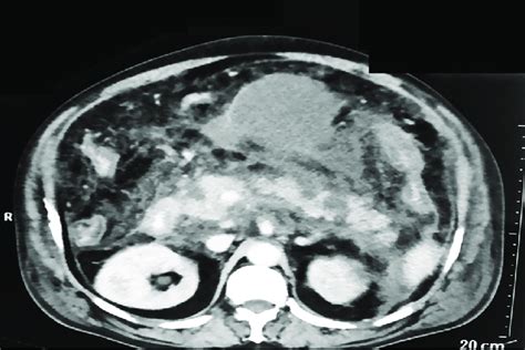 Contrast Enhanced Computed Tomography Of The Abdomen Demonstrating