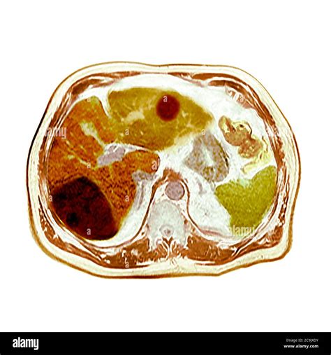 Liver Cancer Coloured Axial Computed Tomography Ct Scan Through The Abdomen Of An 80 Year Old