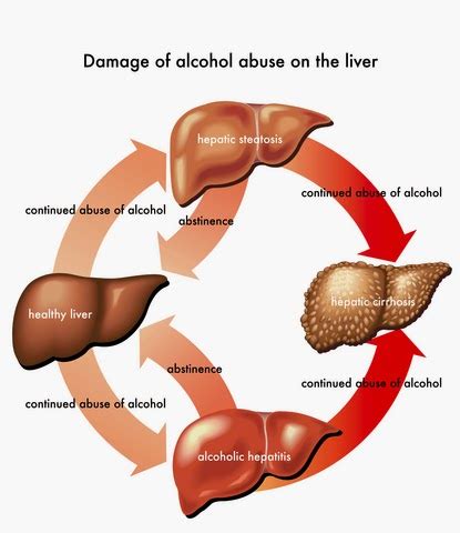 Alcoholic Liver Disease