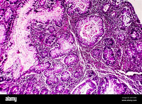 Villous Colon Adenocarcinoma Light Micrograph Photo Under Microscope