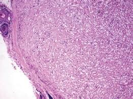 Clear Cell Fibrous Papule | MDedge Dermatology