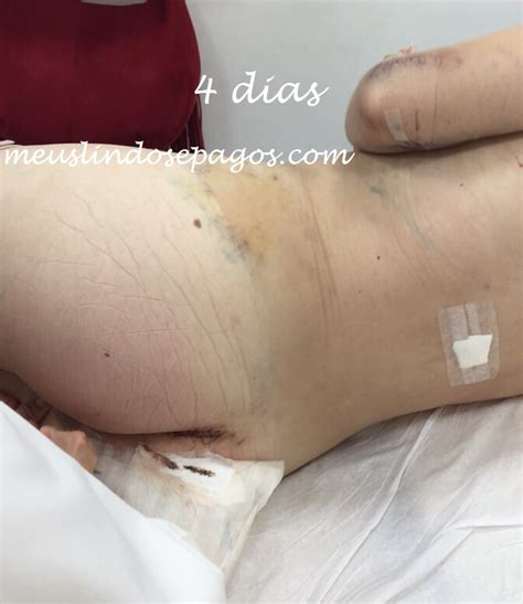 Meus Lindos E Pagos Arquivos Gluteoplastia Ml Lifesil Redonda