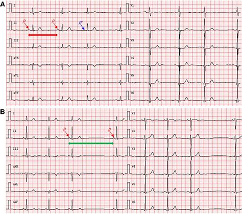 Twelve-lead synchronous ECG shows sinus node conduction abnormalities ...