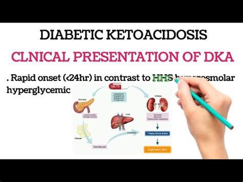 Diabetic Ketoacidosis CLNICAL PRESENTATION OF DKA DIAGNOSTIC