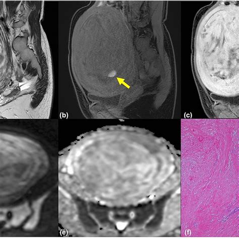 Leiomyoma With Bizarre Nuclei In A 45 Year Old Woman Axial Mri In A Download Scientific