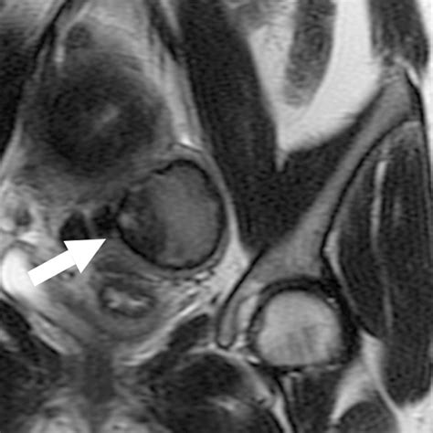 Increased Speed And Image Quality For Pelvic Single Shot Fast Spin Echo