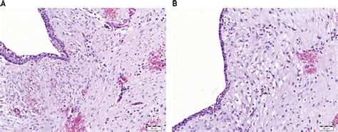 Symptomatic Rathke Cleft Cyst In Paediatric Patients Clinical