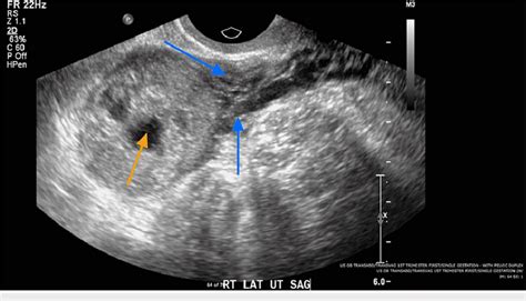 Transvaginal ultrasound indicating echogenic structure in the right ...