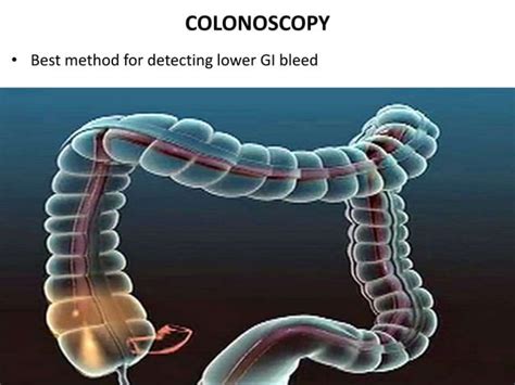 gastrointestinal bleeding ( GI Bleed) | PPT