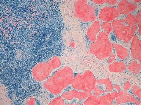 Amiloidosis Hereditaria Por Transtiretina Una Enfermedad No Tan Rara