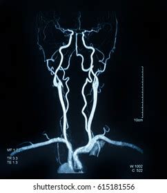 Mri Blood Vessels Brain Cerebrovascular Disease Stock Photo 615181556 ...