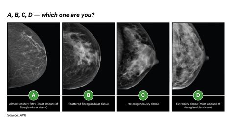 Know Your Breast Density Know Your Cancer Risk How Ai Helps Patients