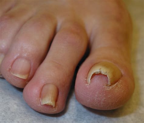 An Atlas Of Nail Disorders Part 7 Consultant360