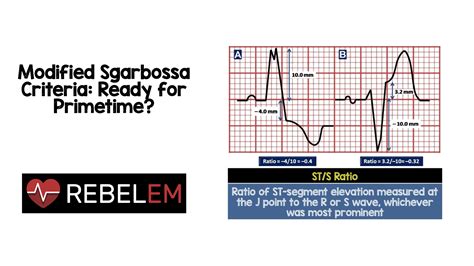 Modified Sgarbossa Criteria - REBEL EM - Emergency Medicine Blog