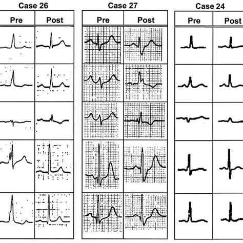 (A) ECG showing minimal preexcitation (rsR= pattern in lead III) only... | Download Scientific ...