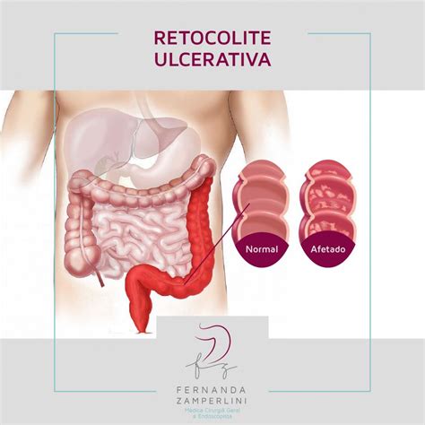 A Retocolite Ulcerativa é uma doença inflamatória sem cura mas