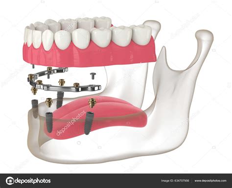 Render Bar Retained Removable Overdenture Installation Supported ...