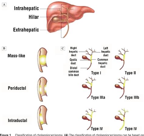 Cholangiocarcinoma Type