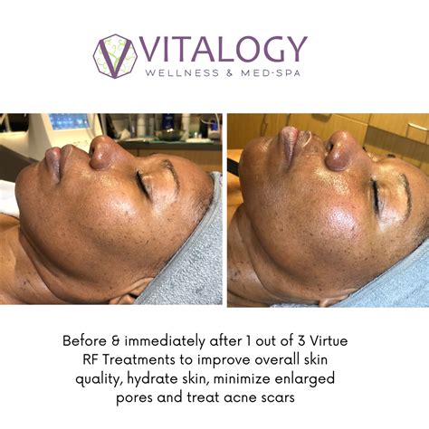 Gallery Virtue RF Microneedling Vitalogy Wellness Med Spa