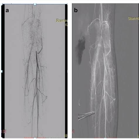 A Multiple Plain Old Balloon Angioplasty Dilatations B Flow After