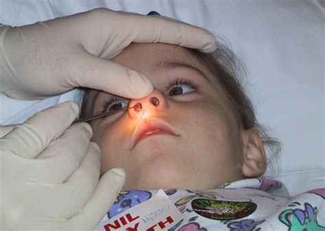 Nasal Foreign Body • Litfl • Clinical Cases Paediatric