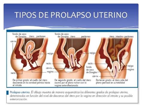 O Que É Prolapso Vaginal - Prolapso Vaginal Estagio 1 Prolapso Genital Femenino: Lo Que Debería