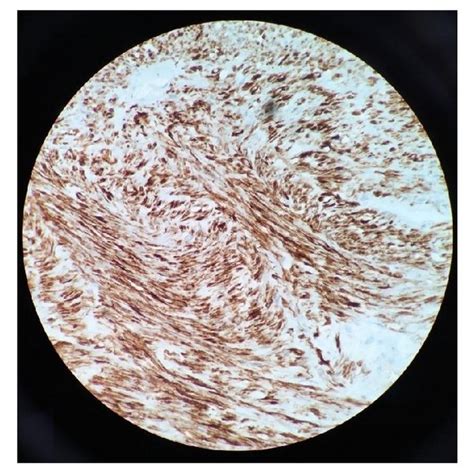 A Proliferation Of Bland Spindle Cells With Elongated Nuclei And