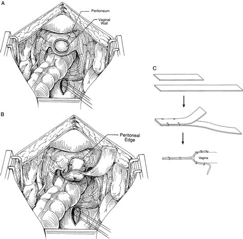 Abdominal Sacral Colpopexy And Abdominal Enterocele Repair In The