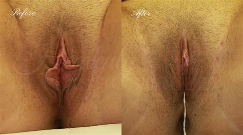 Labiaplasty Gallery Heavenly Plastic Surgery