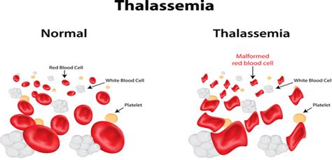 My life with Thalassemia minor (on a plant-based-diet)