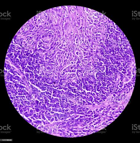 Squamous Papilloma Of Lamber Spine Area To The Human Papilloma Virus