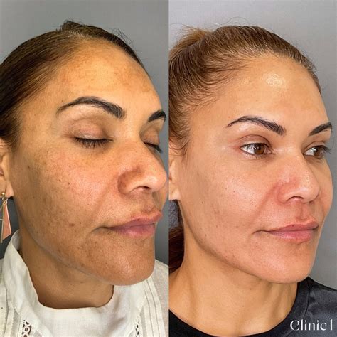 How To Treat Melasma With Clinic 1 Aesthetics — Clinic 1 Auckland