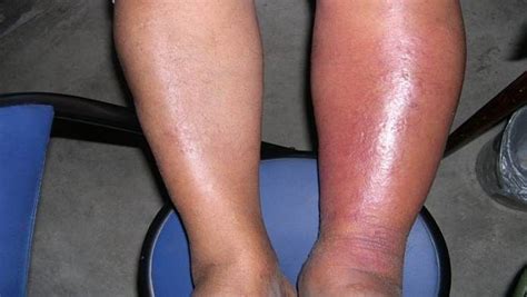 9 best Cellulitis leg images on Pinterest | Cellulitis infection ...