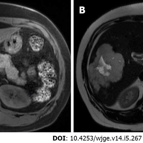 Magnetic Resonance Imaging With T1 Hypointense And T2 Mildly