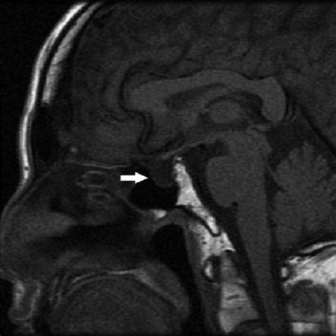 Sagittal Image Obtained By Mri Showing The Hypoplastic Pituitary Gland