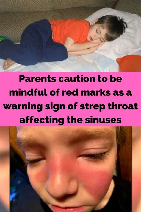 Seven Signs You Have Strep Throat Artofit