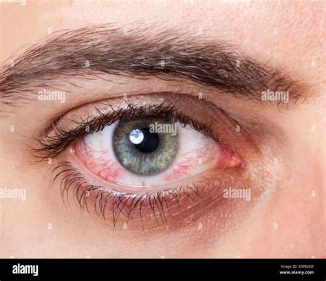 Close Up of irritated red blood eye Stock Photo - Alamy