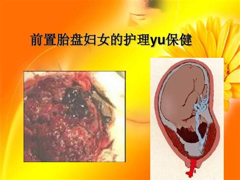 前置胎盘妇女的护理word文档在线阅读与下载无忧文档