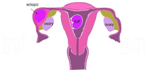 Heterotopic pregnancy. | Download Scientific Diagram